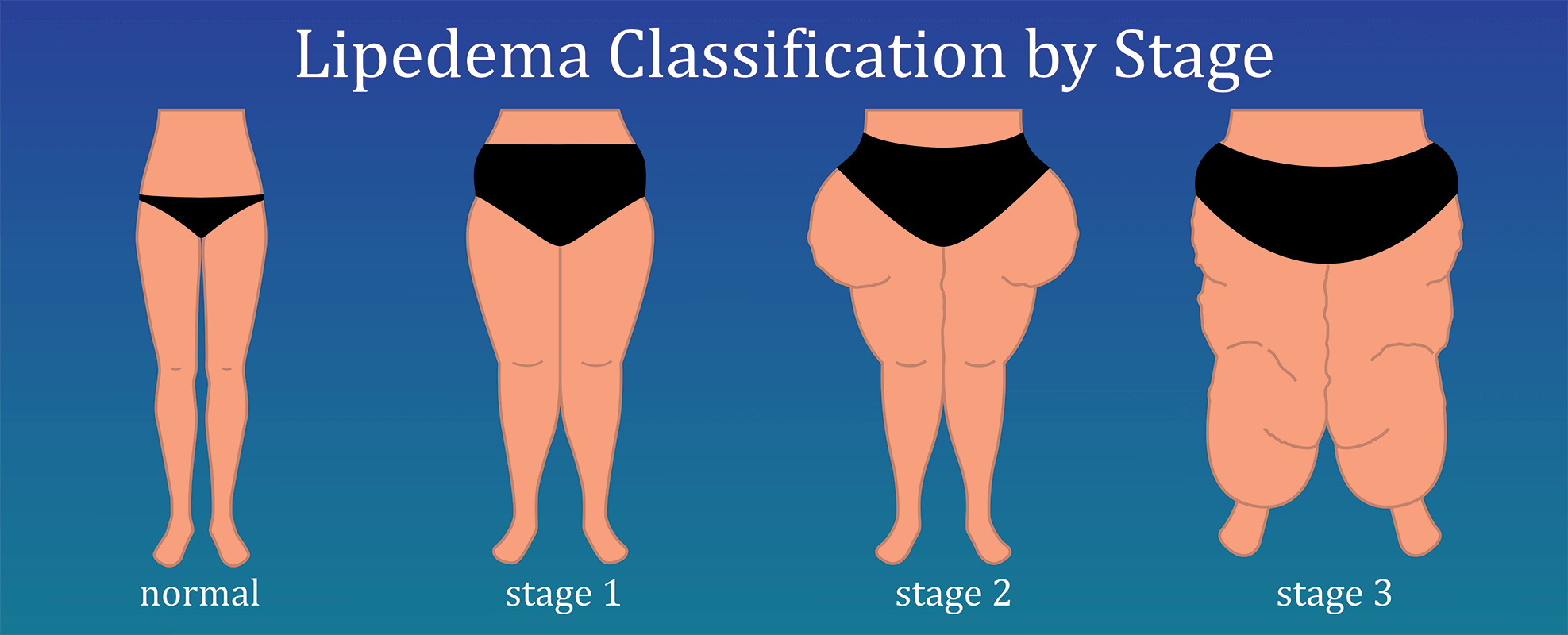 Illustration of lipedema classifications by stage, including normal, stage 1, stage 2, and stage 3.
