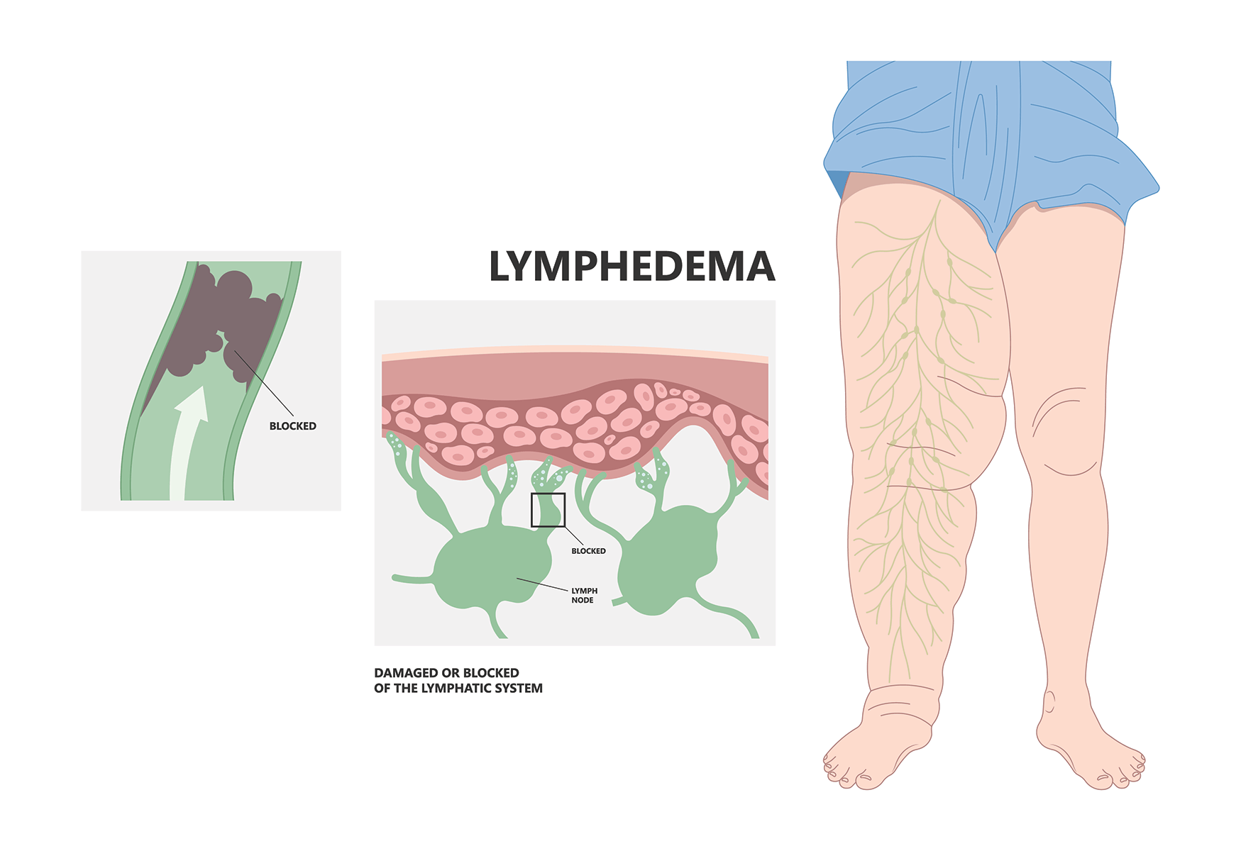 Illustration of a leg with lipedema