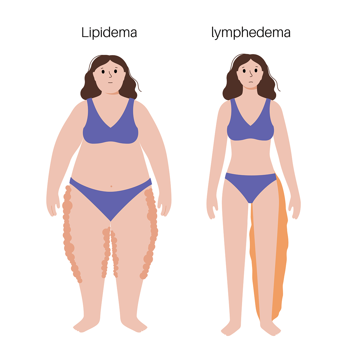 Illustration of lipedema vs lymphedema